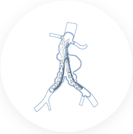 Hercules™ Bifurcated Stent Graft System